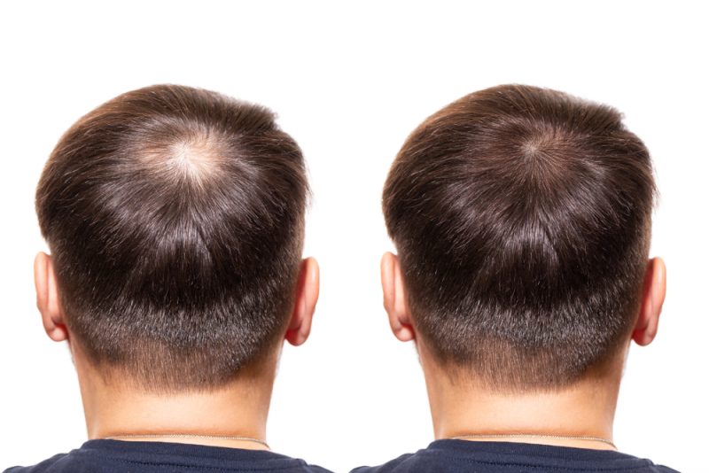Direct Hair Implantation (DHI)