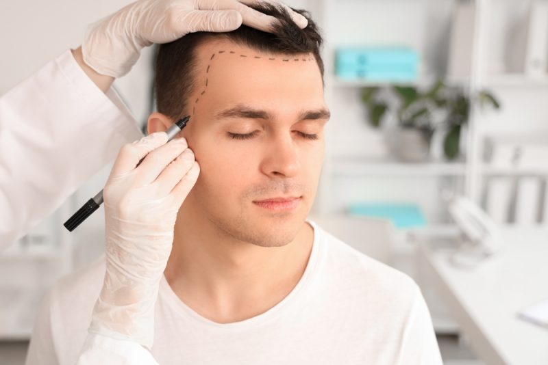 direct hair implantation
