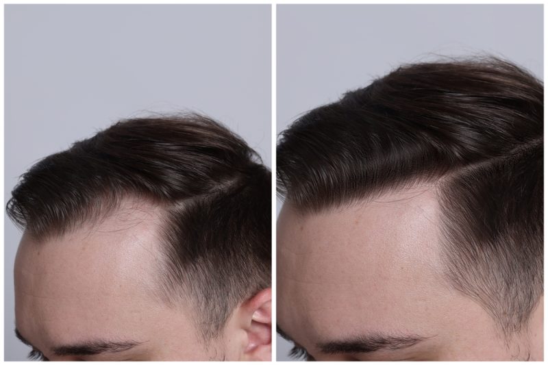 haartransplantatie